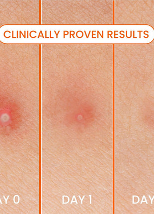 Biore Cover & Conquer Blemish Patches, Ultra-Thin Hydrocolloid, 30 Ct | Medical Grade Design, Covers Zits & Blemishes, Discreet Wear, HSA/FSA Approved, Helps Protect Spots