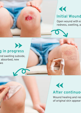 Hydrocolloid Roll for Wound Care Skin-Friendly Self Adhesive 2in x 12ft | Cut-to-Size Waterproof Hydrocolloid Bandages with Flexible Fit for Minor Wounds, Blisters, Pimples, and Friction