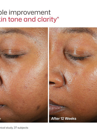 EltaMD UV Clear Face Sunscreen SPF, Oil-Free Sunscreen with Zinc Oxide, Dermatologist Recommended