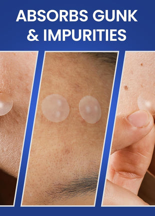 Pimple Patches for Face | Hydrocolloid Acne Patches with Tea Tree Oil & Salicylic Acid | For Zits, Blemishes, Breakouts | Medical-Grade Hydrocolloid | Overnight PM Patches | Pack of 72