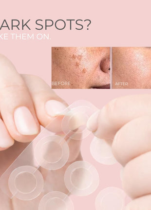 Microdart Pimple Patches- Cystic Acne Patch – Microneedle Pimple Patch for Face, Dark Spots & Blind Pimples- 18ct
