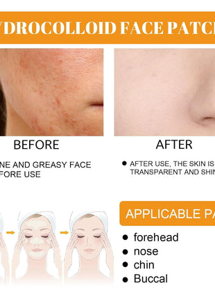 40Pcs Hydrocolloid Acne Patches Full-Face Coverage Kit for Pimples & Blemishes, Skin Care Solution for Clearing Spots