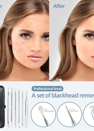 JPNK Blackhead Remover Comedone Extractor Acne Removal Kit..