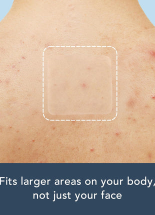Rael Miracle XL Spot Control Cover Hydrocolloid Large Pimple Patches (8 Ct) | Large, Customizable Protective Patch for Face, Back, Chest, Body, Absorbs Fluid From Blemishes, Korean Skin Care, Pore Care