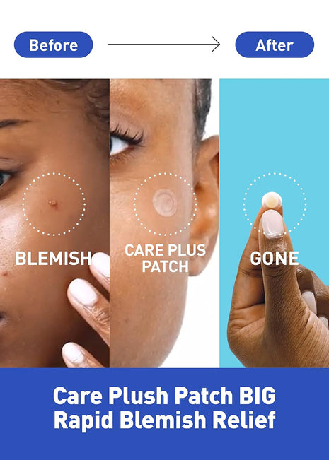 OLIVE YOUNG Care Plus Spot Patch | Hydrocolloid Acne Korean Spot Patch to Cover Zits, Pimples and Blemishes, for Troubled Skin and Face (Hydrocolloid, 306 Count (Pack of 3))