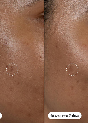 Hero Cosmetics Dark Spot Correct Spot-Fading 15% Vitamin C plus Hyaluronic Acid Serum. Improves the Look of Post Blemish Marks in 7 Days. Twist Applicator and Rollerball Tip for Easy Application. 10mL