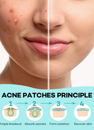 TKTK Pimple Patch for Face, Hydrocolloid Acne Absorbing Dots, 4 Sizes 140CT