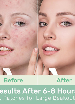 POINTMASS Large Pimple Patches for Face and Body, Hydrocolloid Acne Patches for Big Zit Breakouts and Blemish, Acne Spot Treatment w/Tea Tree Oil for Chin, Nose, Forehead, Body, Back, Neck & Chest