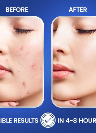 Pimple Patches for Face | Hydrocolloid Acne Patches with Tea Tree Oil & Salicylic Acid | For Zits, Blemishes, Breakouts | Medical-Grade Hydrocolloid | Overnight PM Patches | Pack of 72