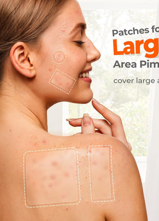 TKTK Large Pimple Patches for Face, 7 Sizes XL Acne Patches, Big Hydrocolloid Bandages for Body, Chin, Forehead, Chest, Back Zit Breakouts, Hydrocolloid Patch (Strip, Square, Dot 302 Count)