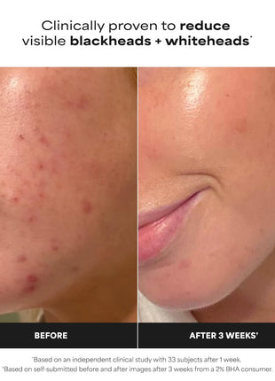 Paula's Choice SKIN PERFECTING 2% BHA Liquid Exfoliant with Salicylic Acid, Facial Polish for Pores, Wrinkles & Fine Lines, Suitable for Blackhead-Prone Skin, Fragrance-Free