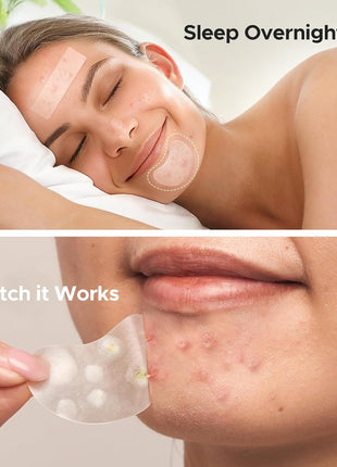 TKTK Pimple Patches Pimple Patches for Face Hydrocolloid Acne Patches Zit Patches for Chin and Nose Skin Care 5 Sizes 280 Count