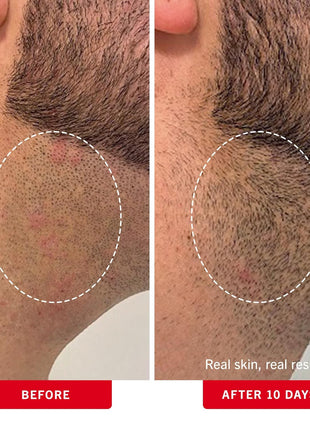 First Aid Beauty - Ingrown Hair Pads with BHA + AHA - Aftershave Treatment Pads to Help Prevent Razor Bumps for Men & Women - Exfoliate Underarms & Bikini Area - Compostable for Daily Use - 28 Pads