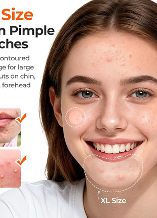TKTK Pimple Patches Pimple Patches for Face Hydrocolloid Acne Patches Zit Patches for Chin and Nose Skin Care 5 Sizes 280 Count