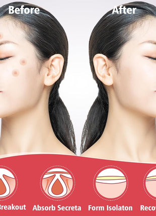 450 Pimple Patches for Face, Hydrocolloid Acne Patches for Zit Covers, Mighty Patch Acne Invisible Zit Patches for Face, 4 Sizes