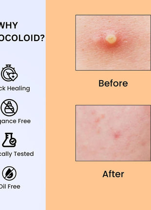Sporty Acne Patches – Hydrocolloid Spot Cover for Zits, Pimples & Blemishes, Fast-Acting Formula, Long-Lasting & Gentle on Skin. (36 Count)