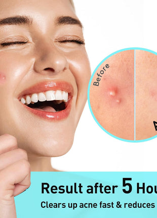 TKTK Pimple Patches, 12mm Invisible Acne Patches for Face with Salicylic Acid, 0.01cm Extra Thin Outer Edge, Hydrocolloid Zit Patch for Pustule, Whitehead, Cystic Acne Spot, 96 Count