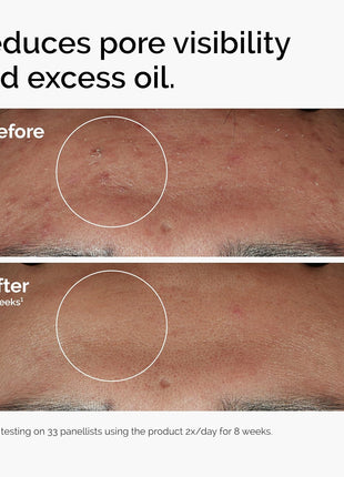 The Ordinary Niacinamide 10% + Zinc 1%, Smoothing Serum for Blemish-Prone Skin