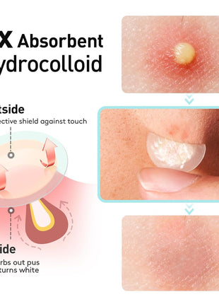 TKTK Pimple Patches, 12mm Invisible Acne Patches for Face with Salicylic Acid, 0.01cm Extra Thin Outer Edge, Hydrocolloid Zit Patch for Pustule, Whitehead, Cystic Acne Spot, 96 Count