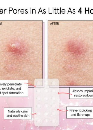 grace & stella Award Winning Multi-Size Pimple Patches for Face | Dermatologist Tested Acne Patches for Face -Hydrocolloid Patch for Breakouts, Whiteheads -Vegan Pimple Patch (Clear, 72 Pack)