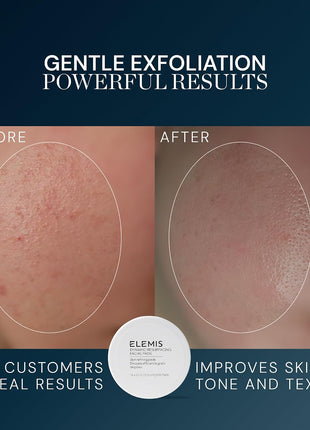 ELEMIS Dynamic Resurfacing Facial Pads, Gentle Textured Treatment