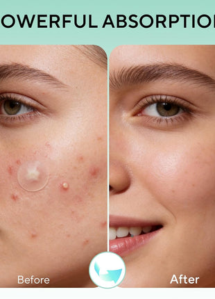 QUSTERE 580 Count Pimple Patches for Face, Large Hydrocolloid Acne Patches Stickers Bandages, Blemishes Zit Breakouts for Cheeks, Forehead, Chin, Nose for Full Face & Body | 7 Sizes | 4 Shapes