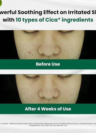 Dr. G R.E.D. Blemish Clear Soothing Cream - Calming Korean Moisturizer for Redness - Soothes Acne & Irritation - With Centella Asiatica - Long-Lasting Hydration - 2.36 fl oz