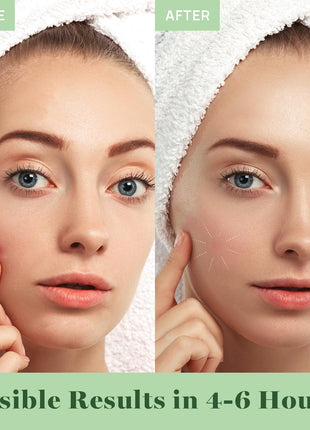 AOA Studio Absorbing Cover Healing Invisible Acne Patch Blemish Spot, Treatment, Facial Acne Patch Vegan, Cruelty Free, Hydrocolloid, Two Sizes 10mm 12mm (Total 84 Counts)
